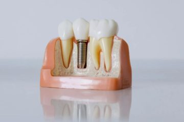 All You Need to Know About Zygomatic Dental Implants